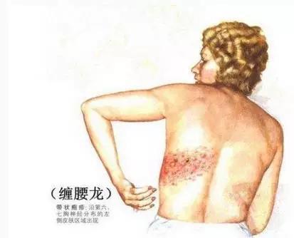 "缠腰火龙","缠腰蛇"长满一圈就死人?