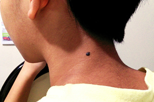 一般而言复合痣与真皮痣较深且凸出,如要除掉,要