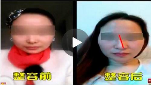 偏要去美容店隆鼻结果她的鼻子被整歪了 预约香港体检美容 9价hpv疫苗 九价子宫颈癌疫苗 Iwsd香港预约官网