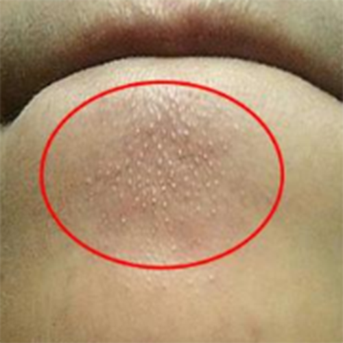 下巴的白色小颗粒是什么?